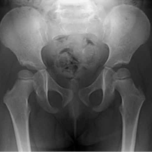 radiografia, pelvis, displasia, menores de 3 meses, bebes, cadera, radio X, medico, examen, orden, medica, quiero mi orden